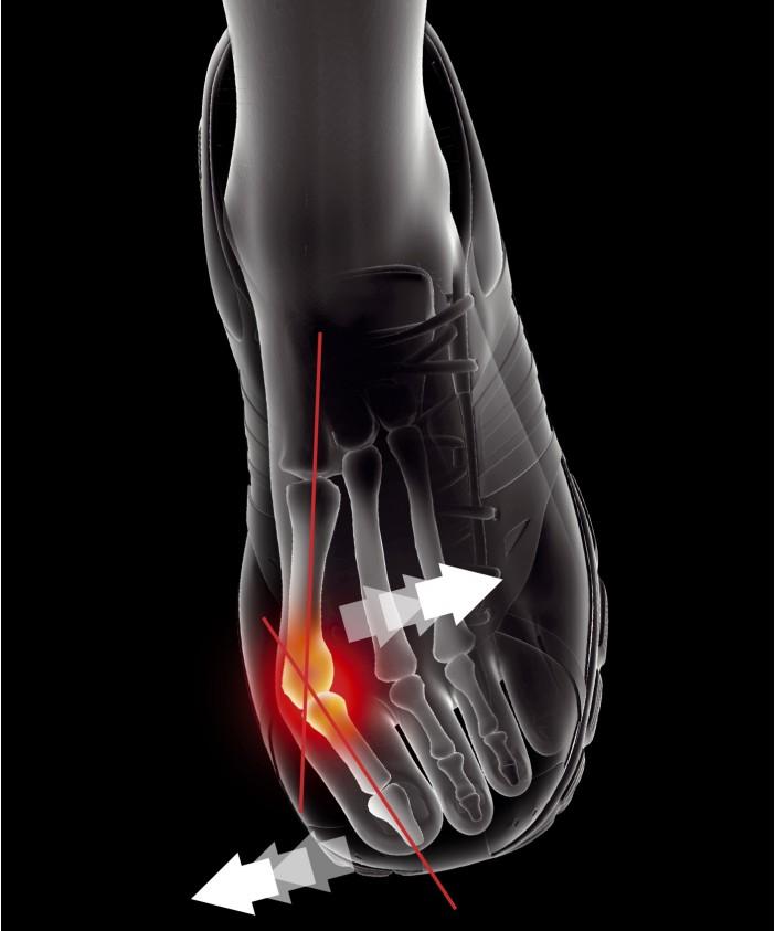 Epitact Bunion Brace / Hallux Valgus EPITHELIUMFLEX 02 Braces Epitact